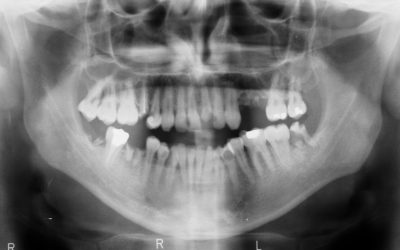 Heart and Periodontal Disease Linked